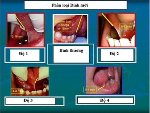 Dính lưỡi (Ankyloglossia) ở trẻ em